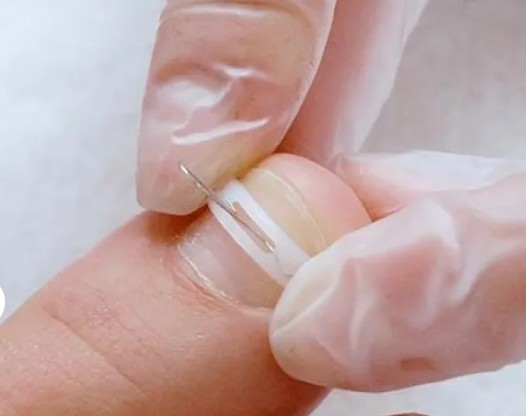 Nagelcorrectie en nagelbeugel behandeling